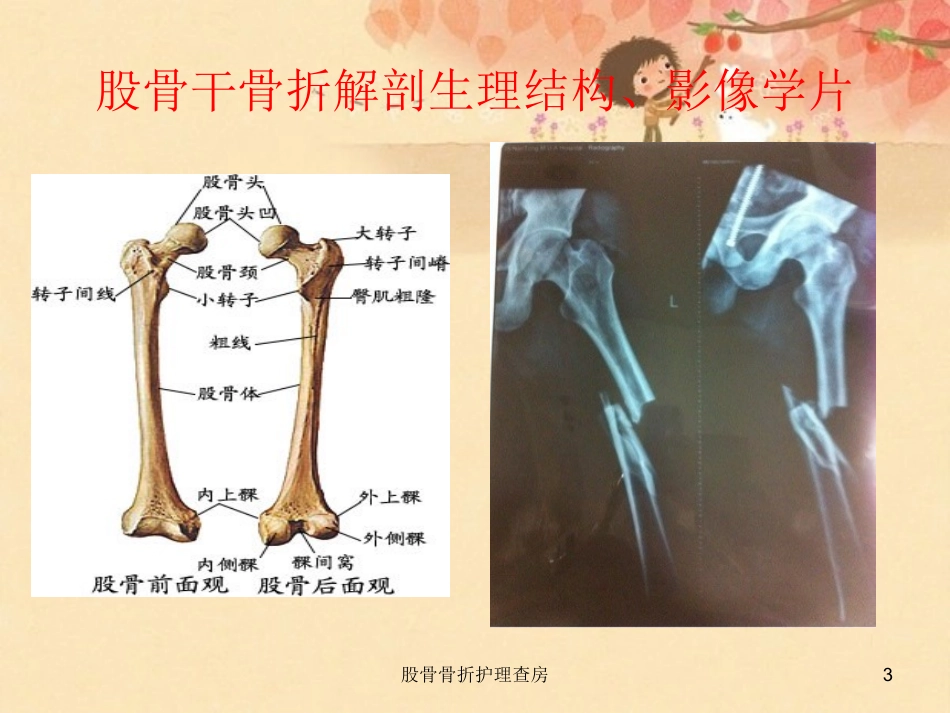 股骨骨折护理查房培训课件.pptx_第3页