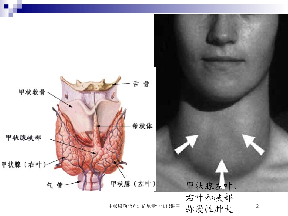 甲状腺功能亢进危象专业知识讲座培训课件.pptx_第2页