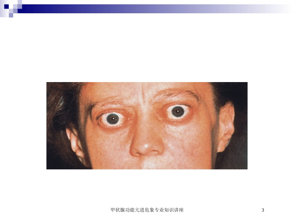 甲状腺功能亢进危象专业知识讲座培训课件.pptx_第3页