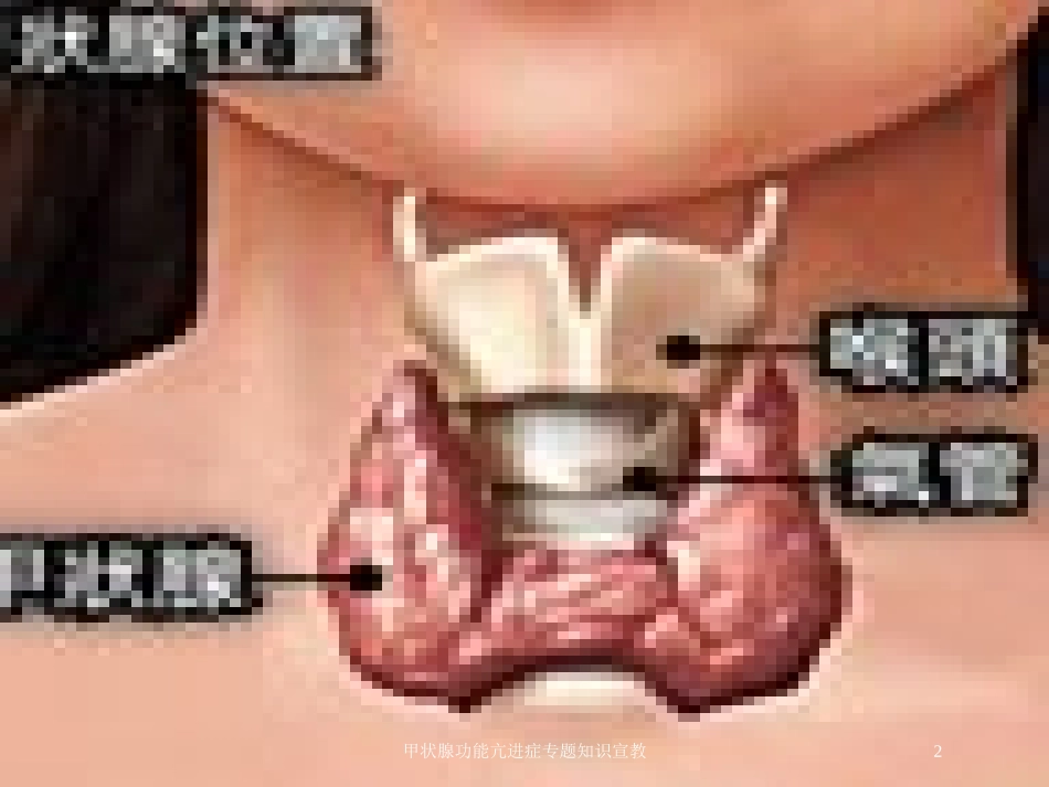 甲状腺功能亢进症专题知识宣教培训课件.pptx_第2页