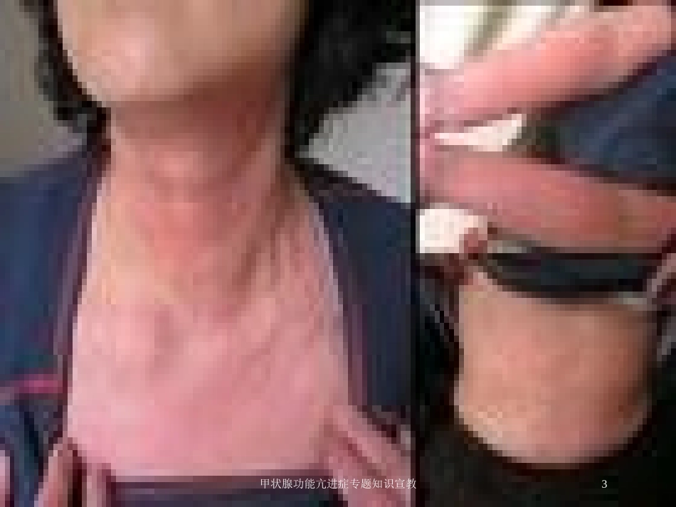 甲状腺功能亢进症专题知识宣教培训课件.pptx_第3页