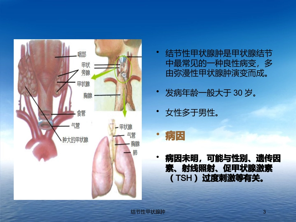 结节性甲状腺肿培训课件.pptx_第3页
