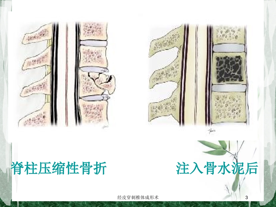 经皮穿刺椎体成形术培训课件.pptx_第3页