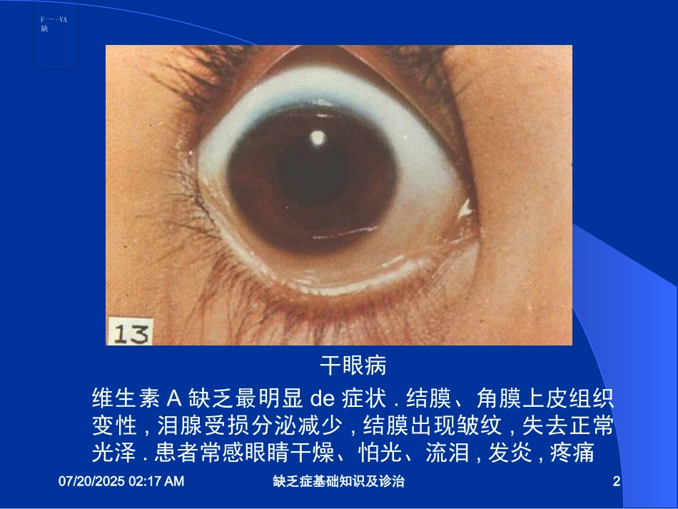 缺乏症基础知识及诊治培训课件.pptx_第2页