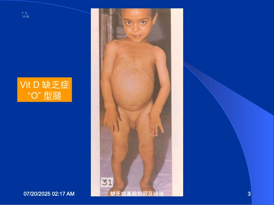 缺乏症基础知识及诊治培训课件.pptx_第3页