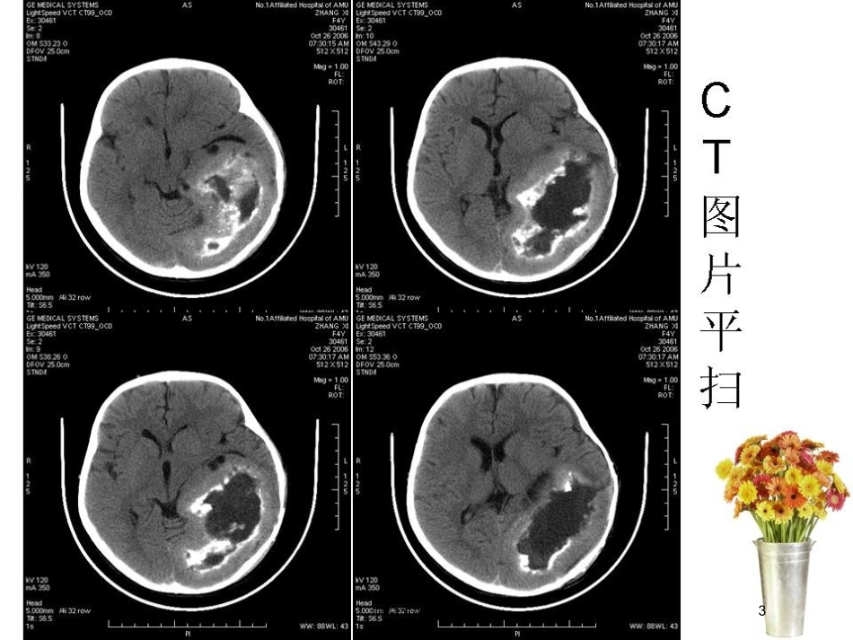 神经节细胞胶质瘤培训课件.pptx_第3页