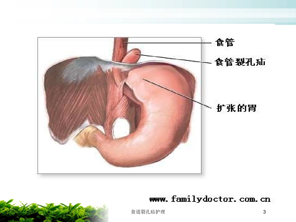 食道裂孔疝护理培训课件.pptx_第3页