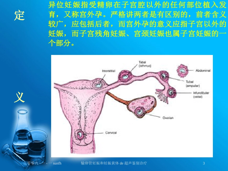 输卵管妊娠和妊娠黄体的超声鉴别诊疗培训课件.pptx_第3页
