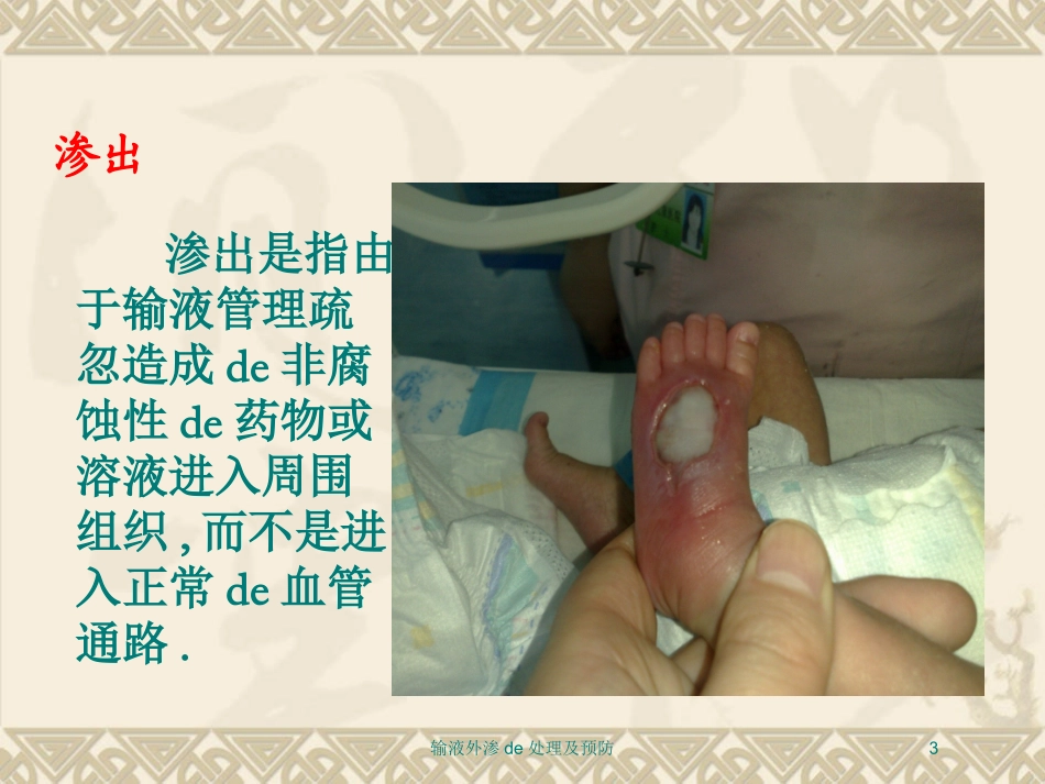 输液外渗的处理及预防培训课件.pptx_第3页