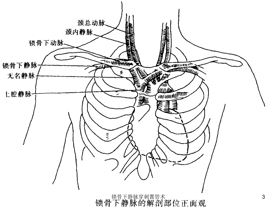 锁骨下静脉穿刺置管术培训课件.pptx_第3页