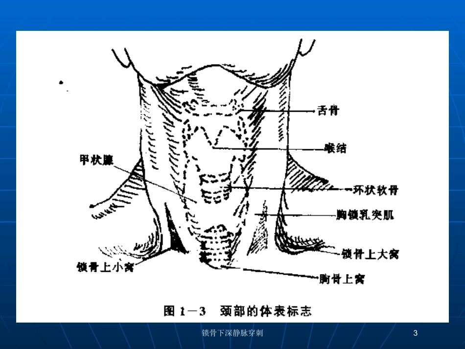 锁骨下深静脉穿刺培训课件.pptx_第3页