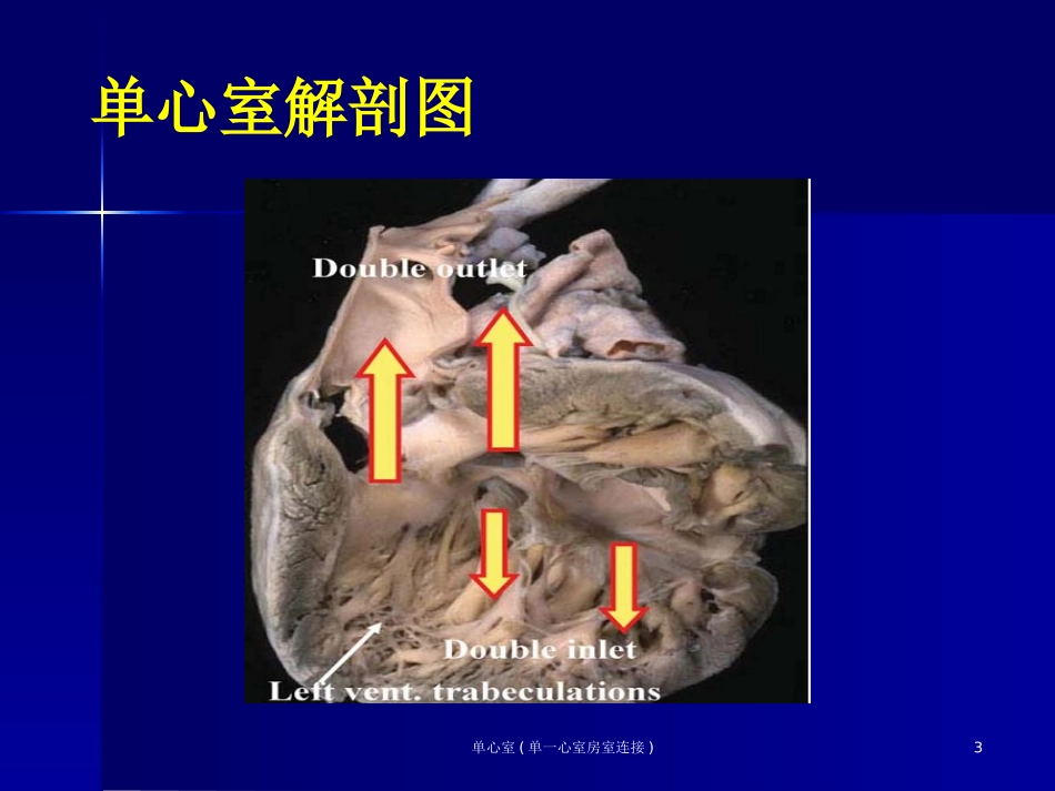 单心室单一心室房室连接培训课件.pptx_第3页