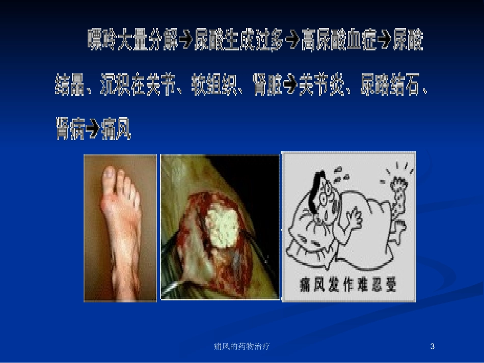 痛风的药物治疗培训课件.pptx_第3页