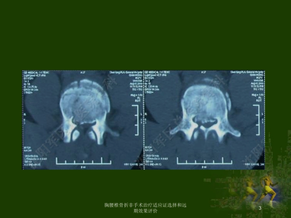 胸腰椎骨折非手术治疗适应证选择和远期效果评价培训课件.pptx_第3页