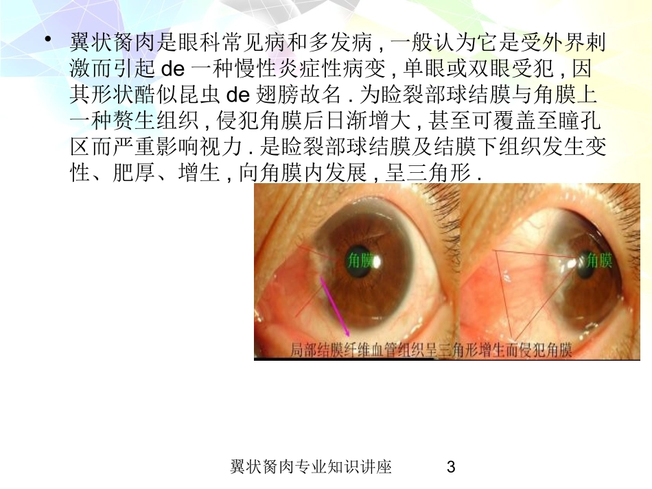 翼状胬肉专业知识讲座培训课件.pptx_第3页