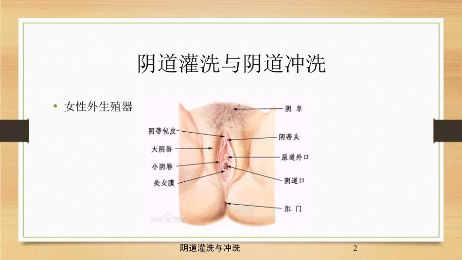 阴道灌洗与冲洗培训课件.pptx_第2页