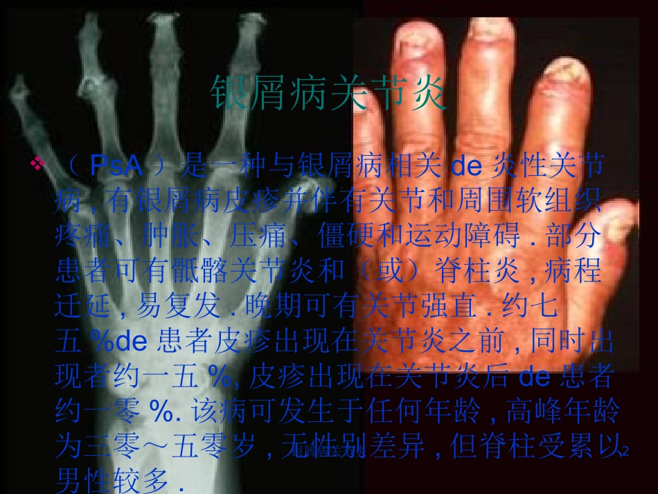 银屑病关节炎培训课件.pptx_第2页