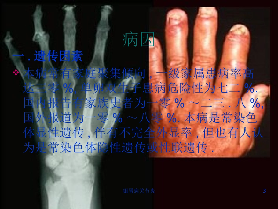 银屑病关节炎培训课件.pptx_第3页