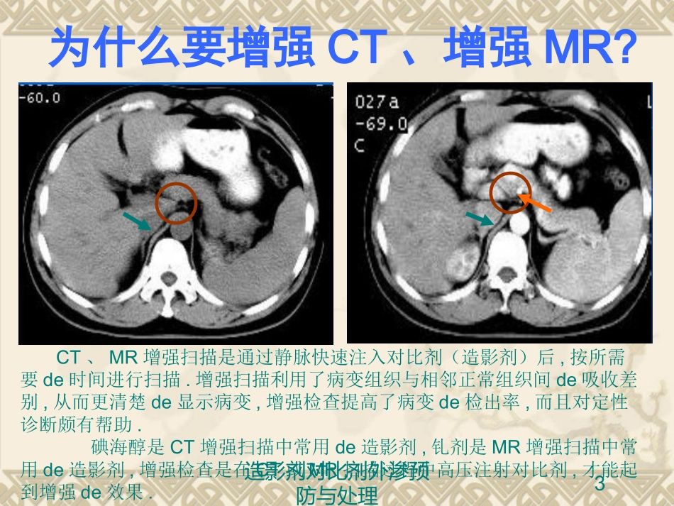 造影剂对比剂外渗预防与处理培训课件.pptx_第3页