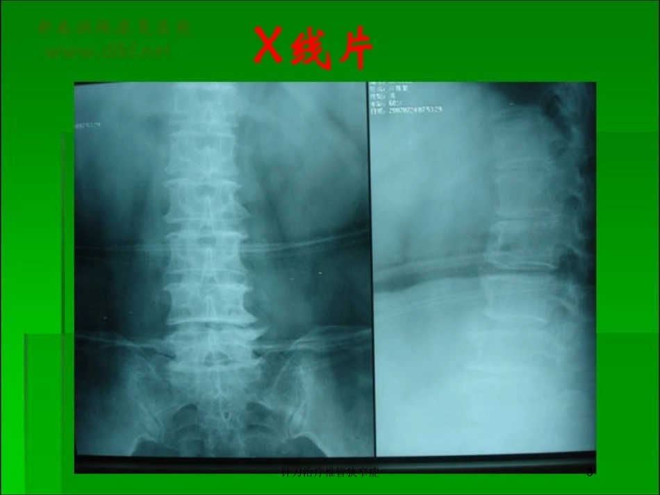 针刀治疗椎管狭窄症培训课件.pptx_第3页