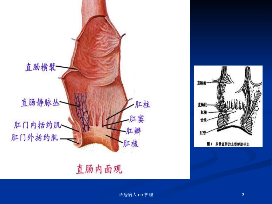 痔疮病人的护理培训课件.pptx_第3页