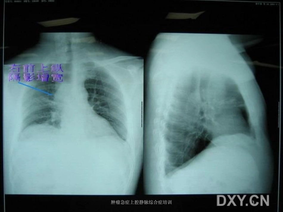 肿瘤急症上腔静脉综合症培训培训课件.pptx_第3页