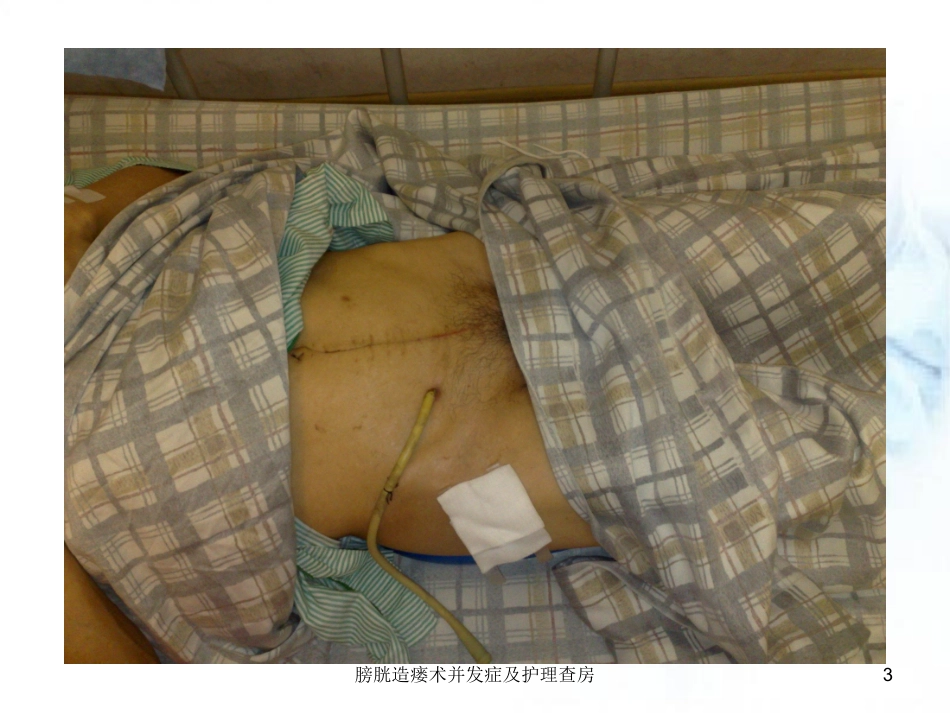 膀胱造瘘术并发症及护理查房培训课件.pptx_第3页