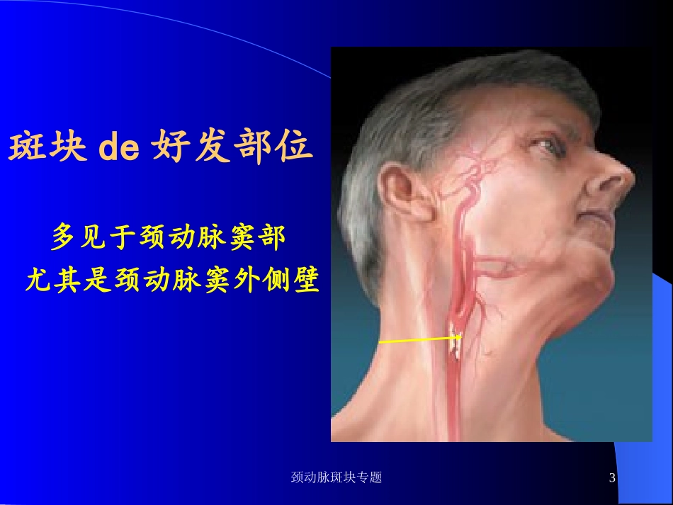 颈动脉斑块专题培训课件.pptx_第3页
