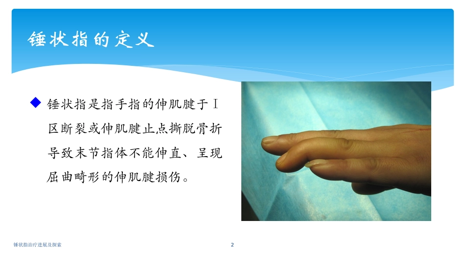 锤状指治疗进展及探索培训课件.pptx_第2页