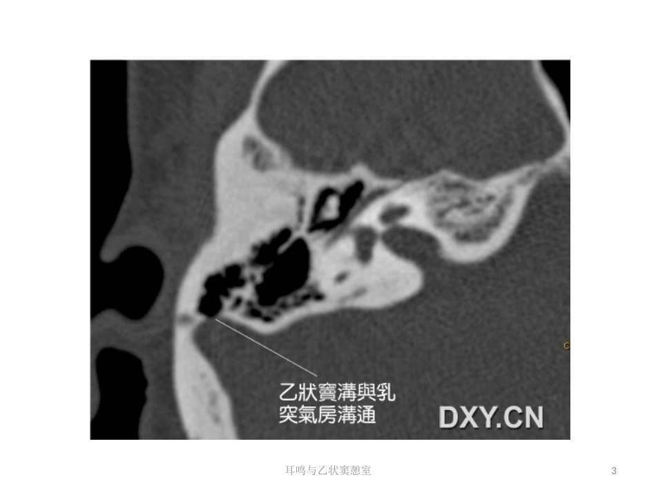 耳鸣与乙状窦憩室培训课件.pptx_第3页