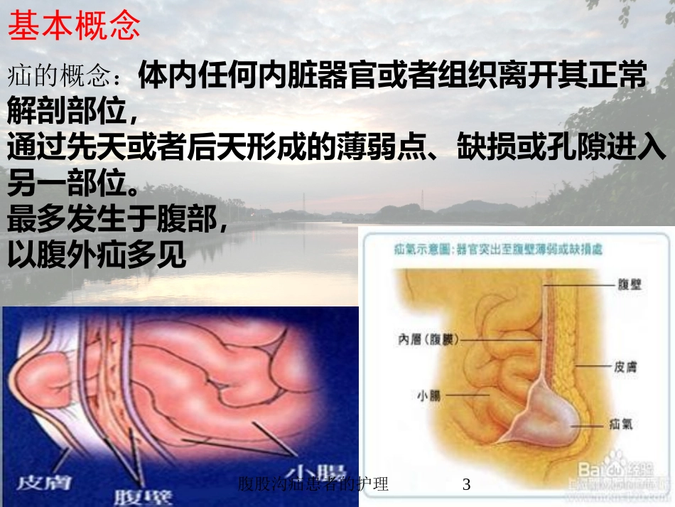 腹股沟疝患者的护理培训课件.pptx_第2页