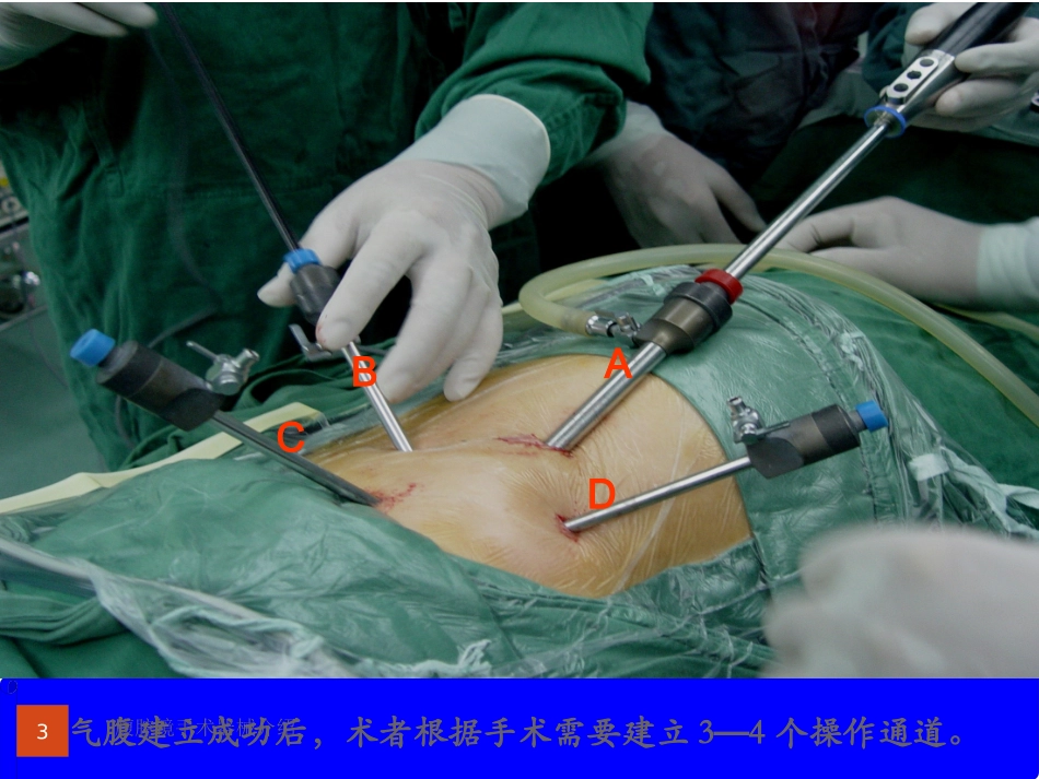 腹腔镜手术器械介绍培训课件.pptx_第3页