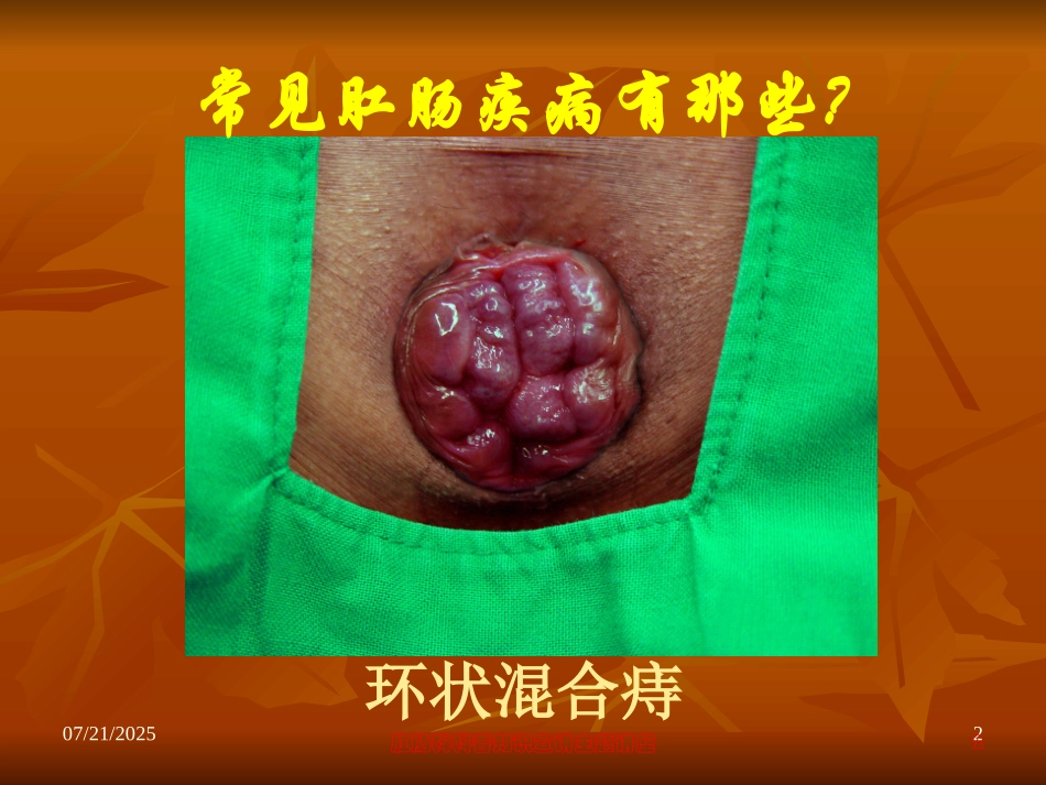 肛肠科科普知识宣讲主题讲座培训课件.pptx_第2页