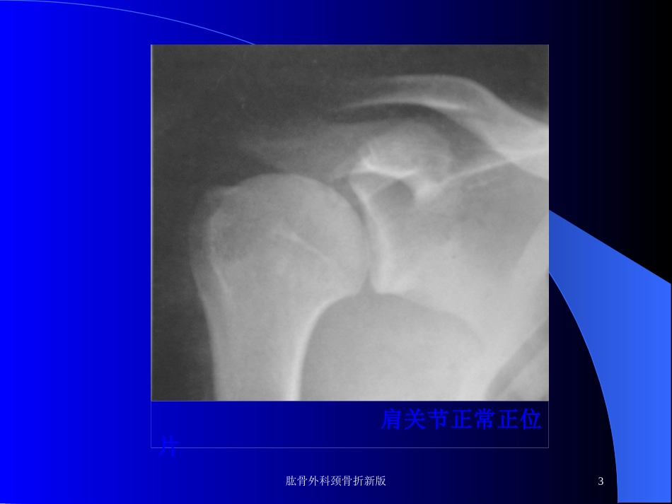 肱骨外科颈骨折新版培训课件.pptx_第3页
