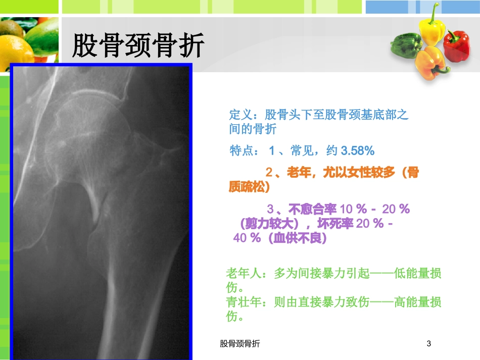 股骨颈骨折培训课件.pptx_第3页