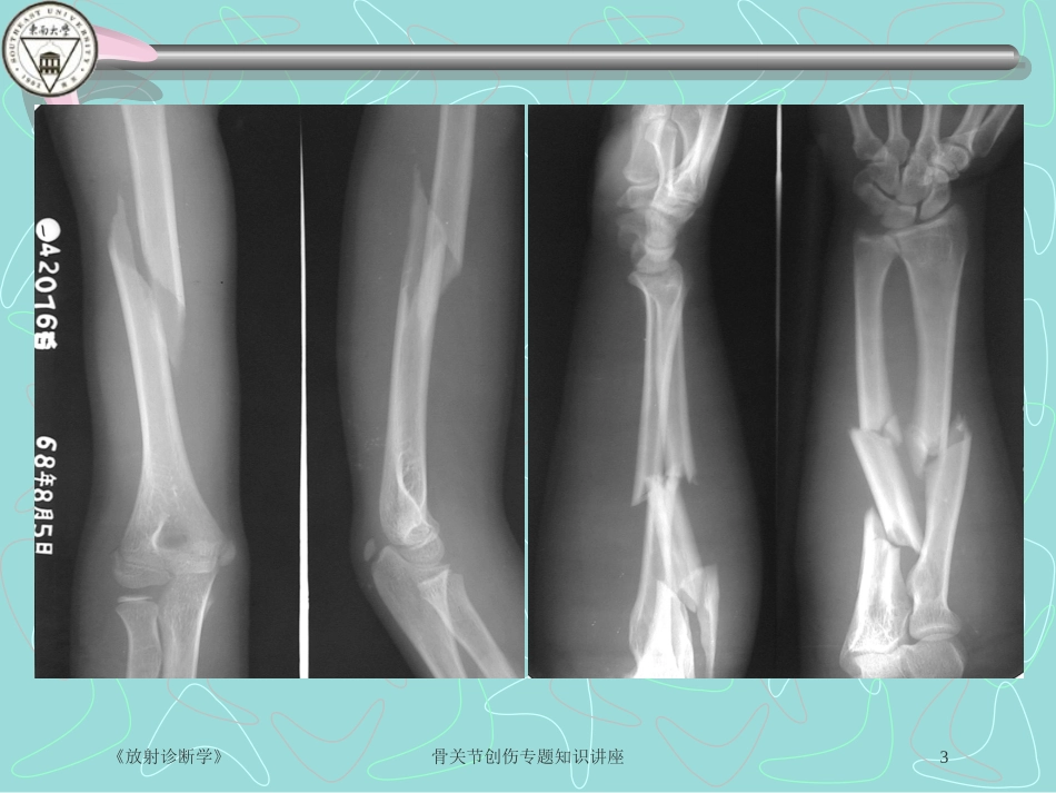 骨关节创伤专题知识讲座培训课件.pptx_第3页