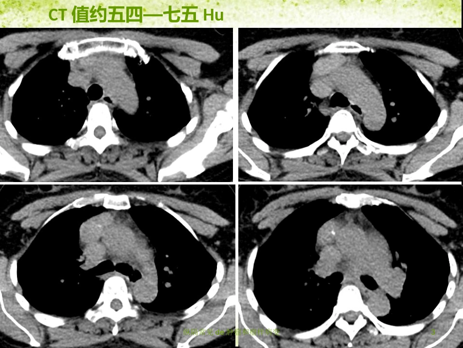 纵隔常见的肿瘤和瘤样病变培训课件.pptx_第3页