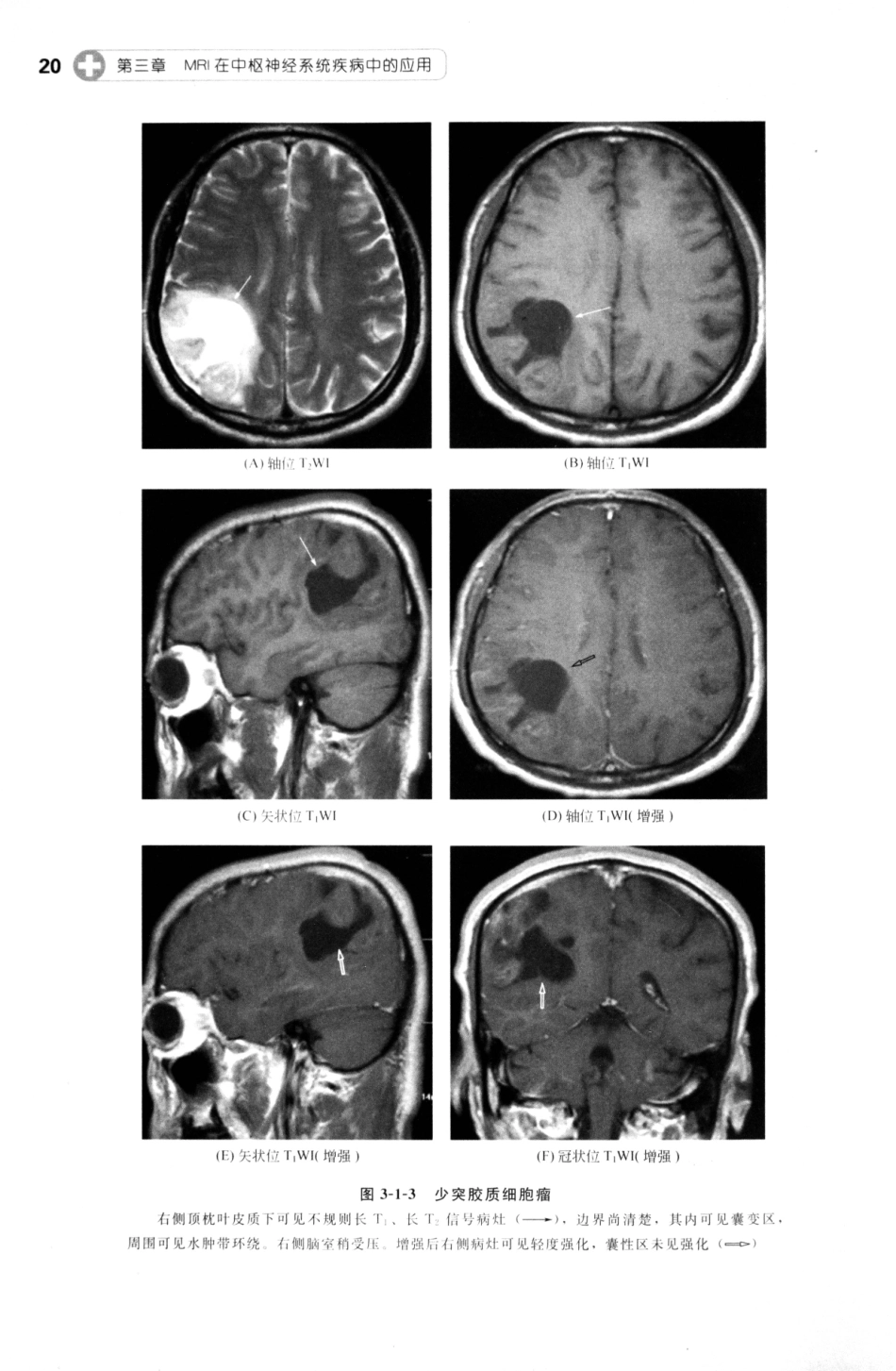 MRI读片指南_13265768_31-45.pdf_第1页