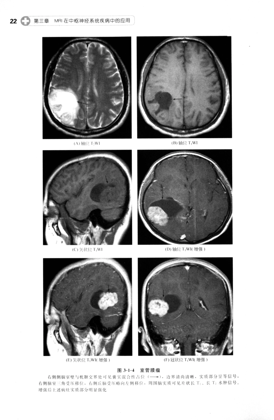 MRI读片指南_13265768_31-45.pdf_第3页