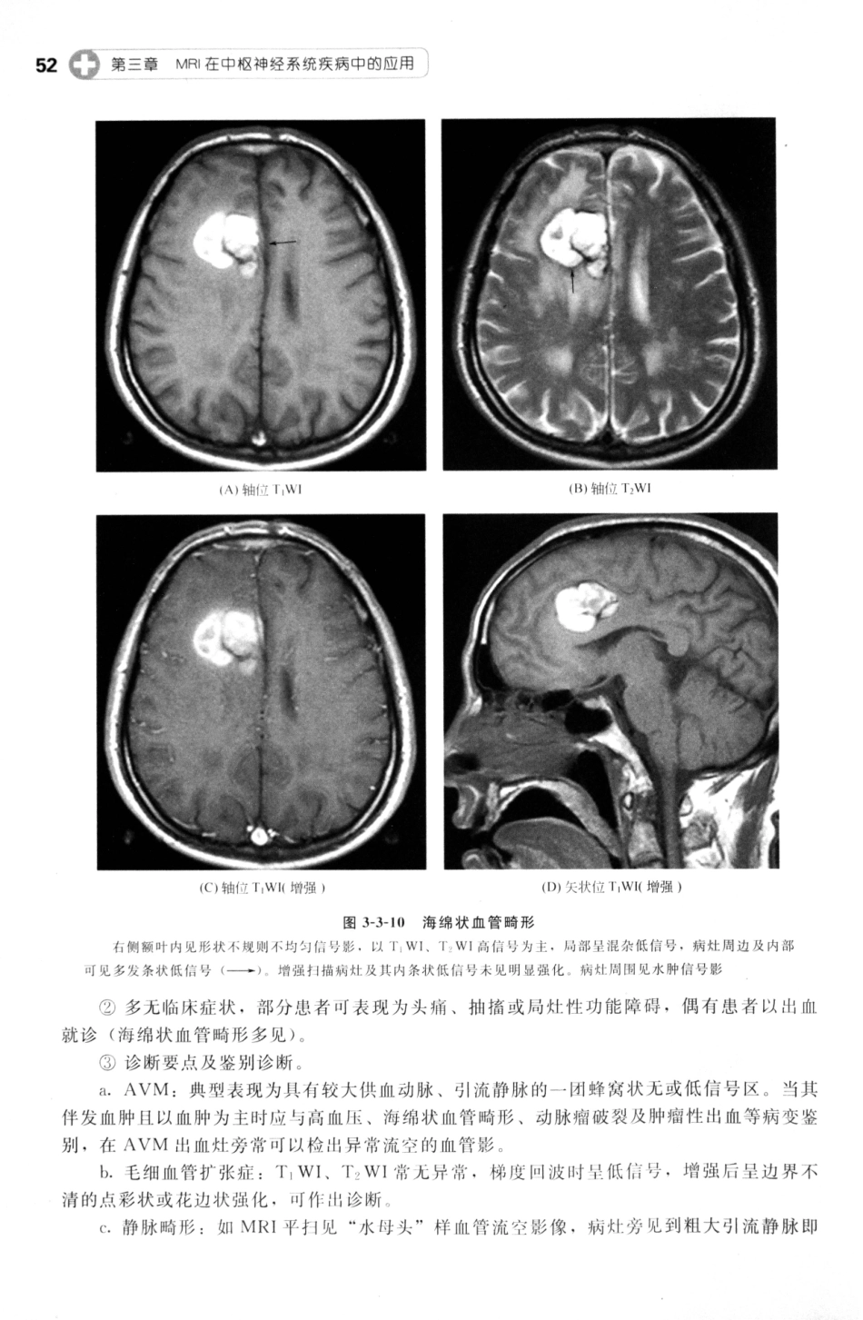 MRI读片指南_13265768_61-75.pdf_第3页