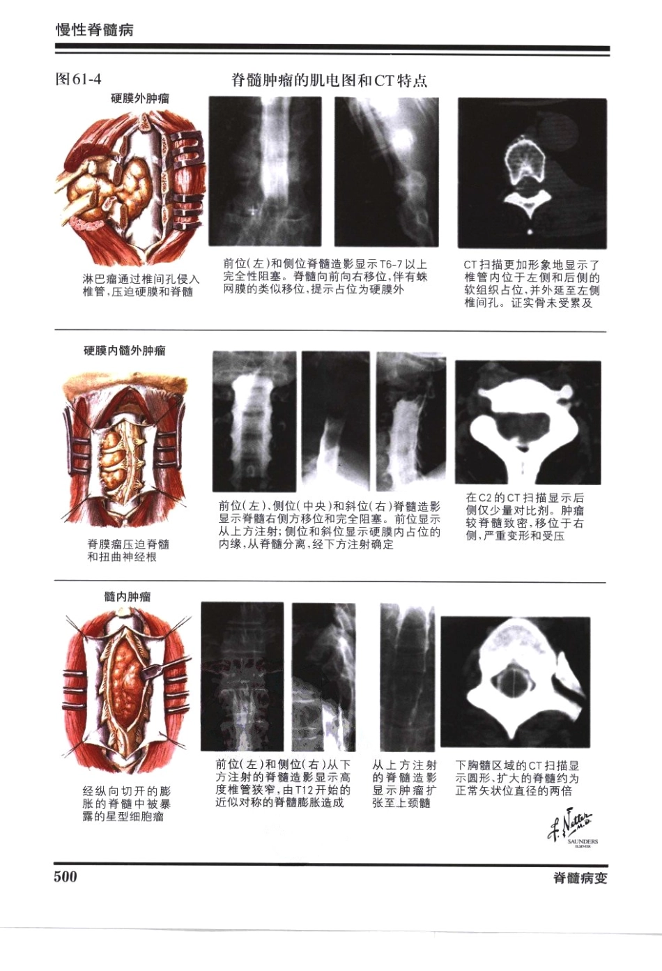 奈特神经系统疾病彩色图谱_樊东升2009译（全彩图）_511-540.pdf_第3页