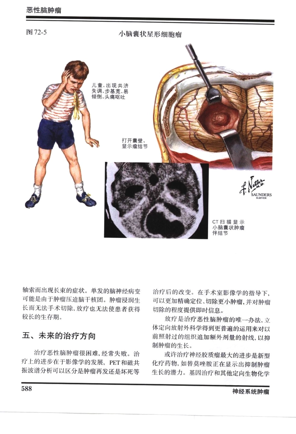奈特神经系统疾病彩色图谱_樊东升2009译（全彩图）_601-630.pdf_第1页