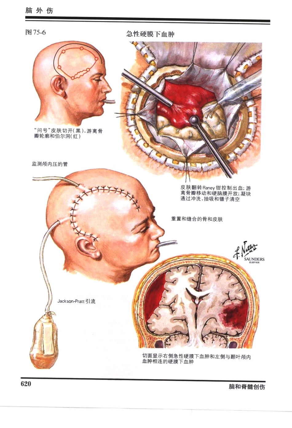 奈特神经系统疾病彩色图谱_樊东升2009译（全彩图）_631-660.pdf_第3页