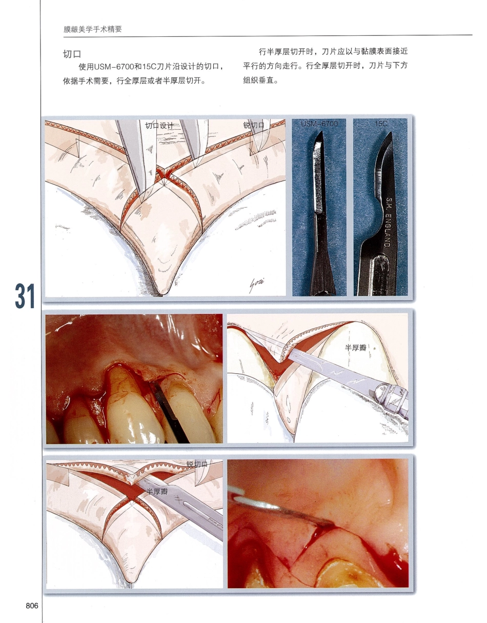 184膜龈美学手术精要_821-831.pdf_第3页