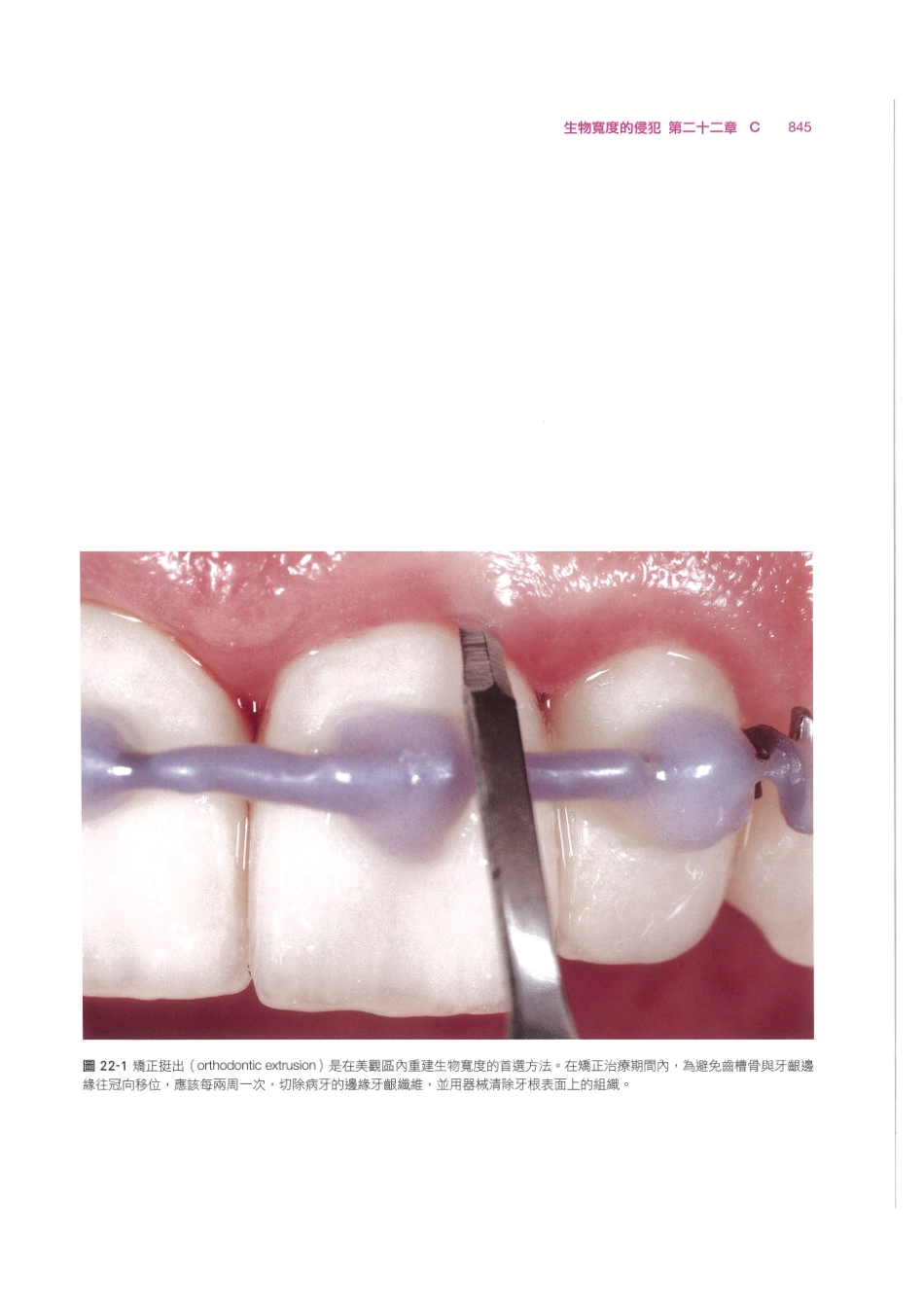 179.牙周整形美容与种植手术_857-864.pdf_第3页