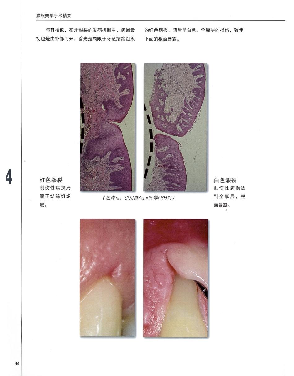 184膜龈美学手术精要_81-100.pdf_第1页