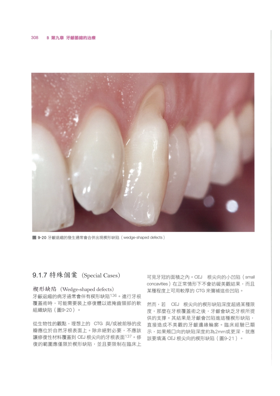179.牙周整形美容与种植手术_321-328.pdf_第2页