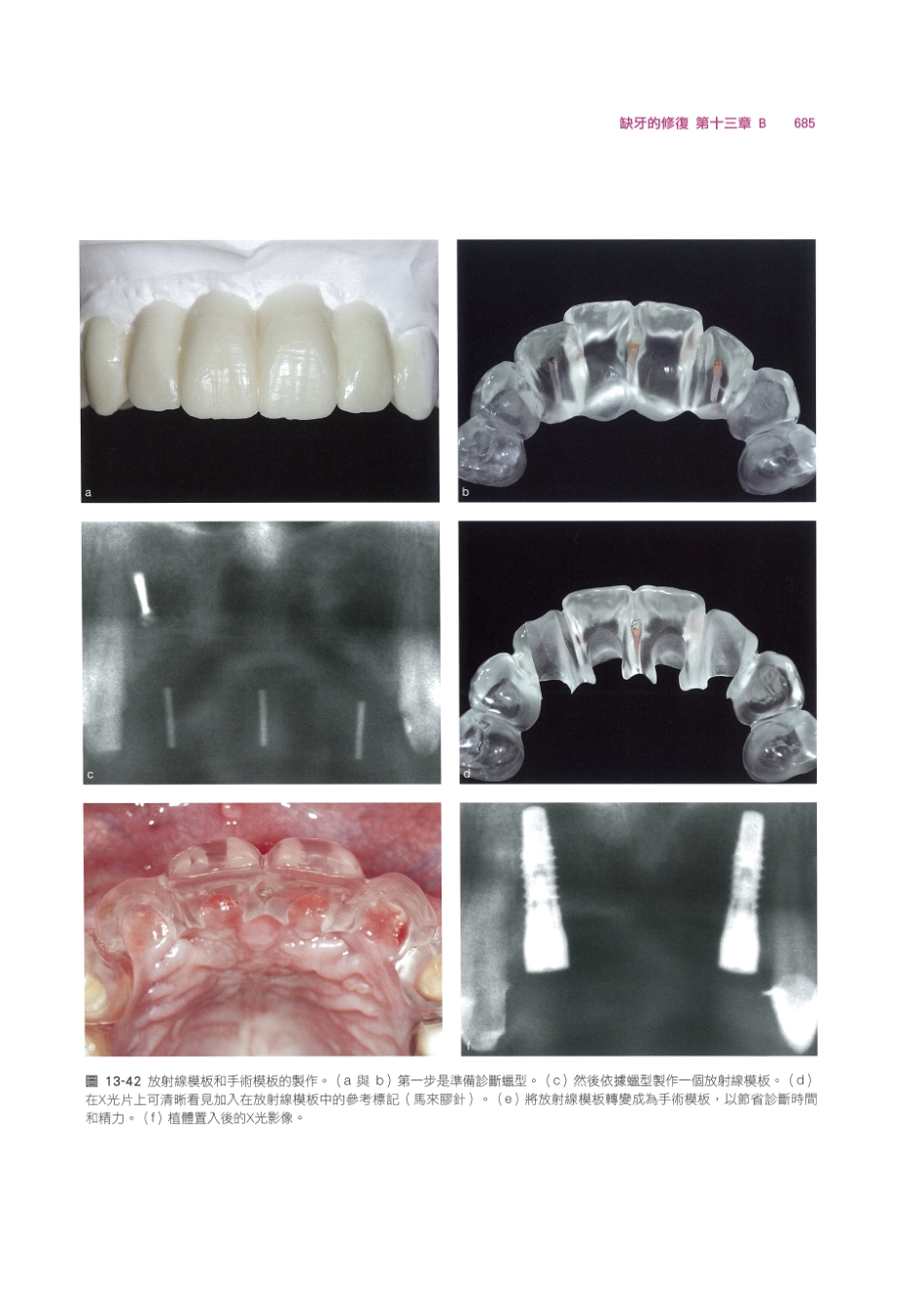 179.牙周整形美容与种植手术_697-704.pdf_第3页