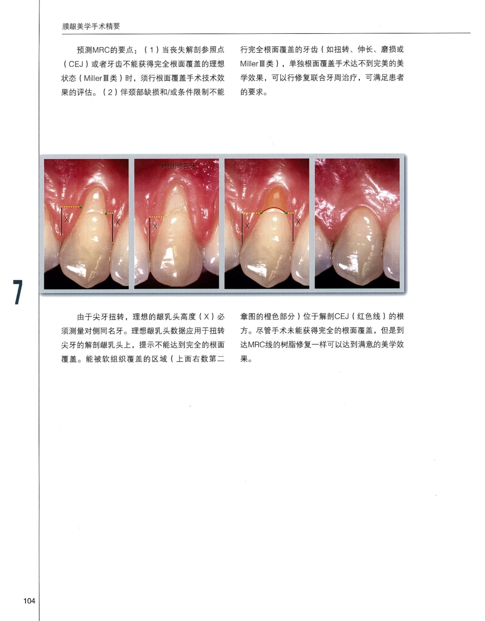 184膜龈美学手术精要_121-140.pdf_第1页