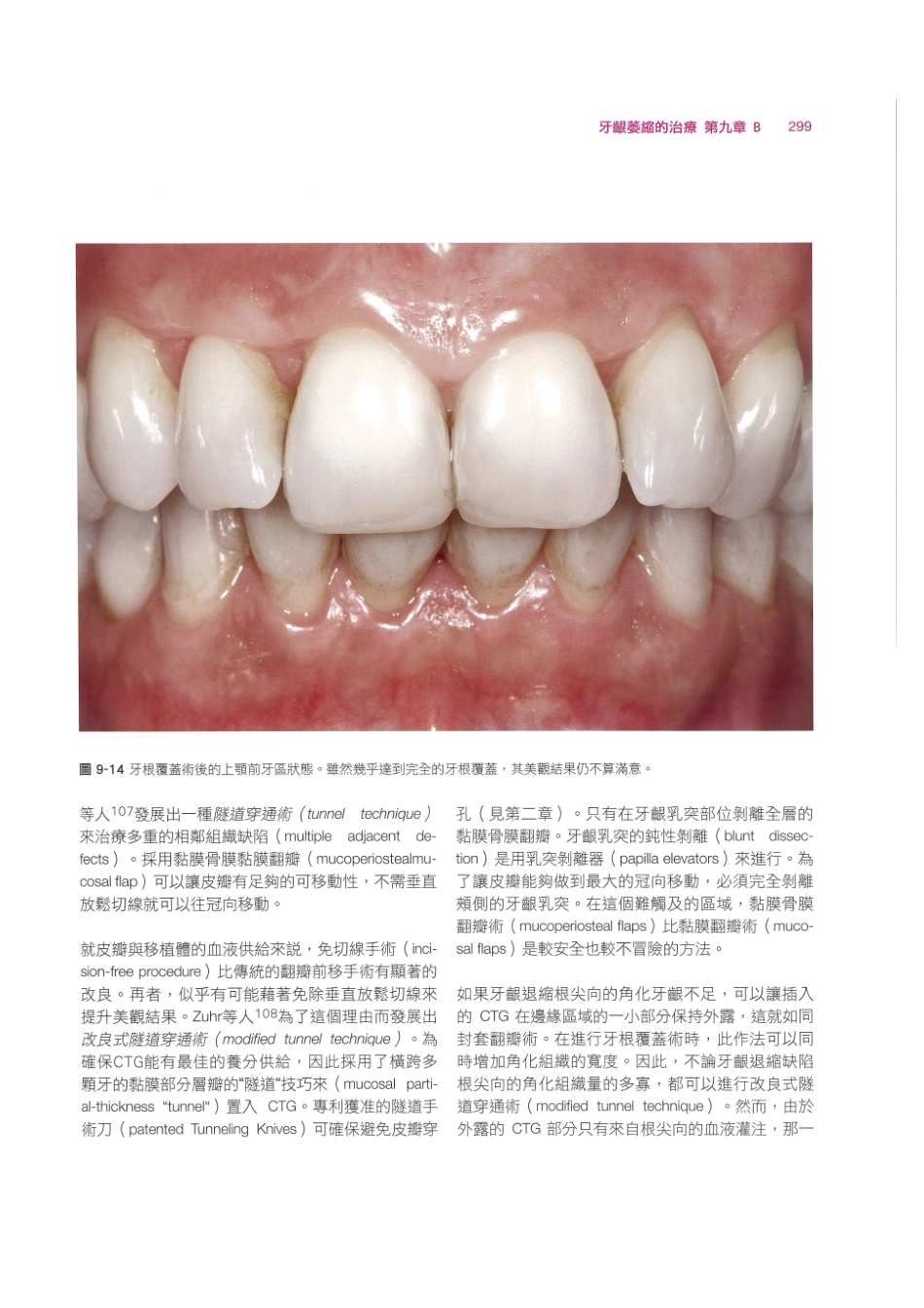 179.牙周整形美容与种植手术_313-320.pdf_第1页